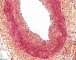 Intimal fibrosis in pulmonary artery