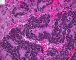Mediastinal poorly differentiated neuroblastoma (Case 11541)