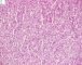 Fetal component of an epithelial hepatoblastoma