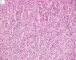 Fetal component of an epithelial hepatoblastoma