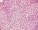 Fetal component of an epithelial hepatoblastoma