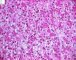 Fetal component of an epithelial hepatoblastoma