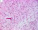 Myxoid liposarcoma