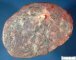 Amnion nodosum