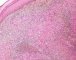 Epithelioid sarcoma