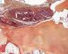 Spindle cell hemangioendothelioma in Maffucci syndrome