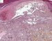 Spindle cell hemangioendothelioma in Maffucci syndrome