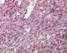 Spindle cell hemangioendothelioma in Maffucci syndrome