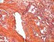 Multifocal lymphangioendotheliomatosis with thrombocytopenia