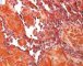 Multifocal lymphangioendotheliomatosis with thrombocytopenia