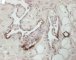 Multifocal lymphangioendotheliomatosis with thrombocytopenia (...)