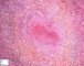 Pulmonary necrotizing granulomatosis and granulomatous vasculitis (etiology (...)