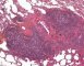 Pulmonary nodular lymphoid hyperplasia
