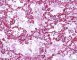Meconial and amniotic aspiration in a newborn