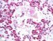 Meconial and amniotic aspiration in a newborn