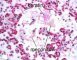 Meconial and amniotic aspiration in a newborn