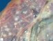 Amnion nodosum
