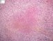 Pulmonary necrotizing granulomatosis and granulomatous vasculitis (etioloy (...)