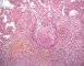 Pulmonary necrotizing granulomatosis and granulomatous vasculitis (etiology (...)