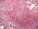 Pulmonary necrotizing granulomatosis and granulomatous vasculitis (etiology (...)