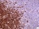 CD20 in nodular lymphocyte predominance Hodgkin disease