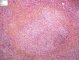 Pulmonary necrotizing granulomatosis and granulomatous vasculitis (etioloy (...)