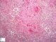 Pulmonary necrotizing granulomatosis and granulomatous vasculitis (etiology (...)
