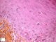 Cutaneous GVH