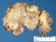 Plexiform neurofibroma in neurofibromatosis type 1 (NF1)
