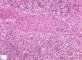 Atypical salivary lymphoid hyperplasia