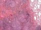 Pulmonary nodular lymphoid hyperplasia