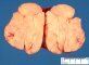 Mesenteric lipoma