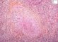 Pulmonary necrotizing granulomatosis and granulomatous vasculitis (etiology (...)