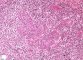 Atypical salivary lymphoid hyperplasia
