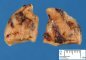 Parathyroid adenoma