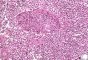 Atypical salivary lymphoid hyperplasia
