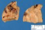 Parathyroid adenoma