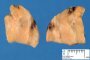 Parathyroid adenoma