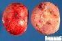 Aldosterone-secreting adrenocortical tumor