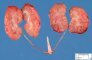 Bilateral non-obstructive renal multicystic dysplasia (BNOMRD) in Meckel (...)