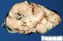 Intra-abdominal immature teratoma